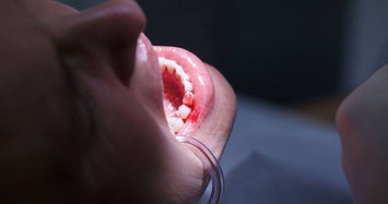 Đi khám ngay nếu có dấu hiệu chảy máu chân răng này