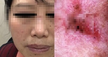 Phát hiện ung thư từ những nốt ruồi trên mặt