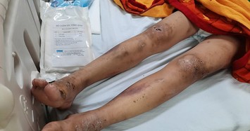 Cô gái trẻ bị gã chủ quán tra tấn dã man ở Biên Hòa - Đồng Nai vì không kích dục cho khách