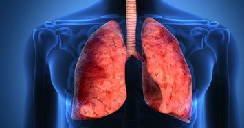 Cảnh báo dấu hiệu ở đầu là triệu chứng của ung thư phổi