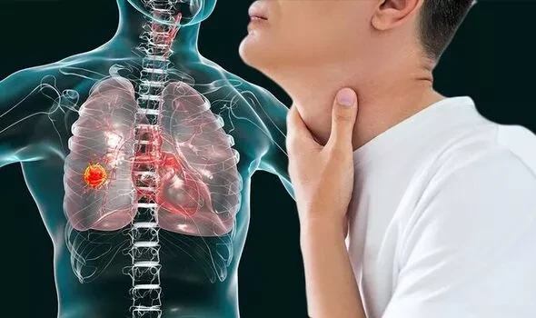 Ung thư phổi và triệu chứng cảnh báo đỏ ở 70% bệnh nhân 
