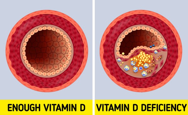 Canh bao lat dau hieu cho thay co the thieu vitamin D tram trong-Hinh-5